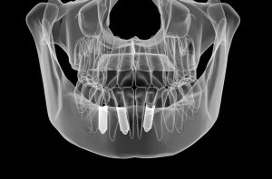 Dental implant and teeth cone bean scanning x-ray view