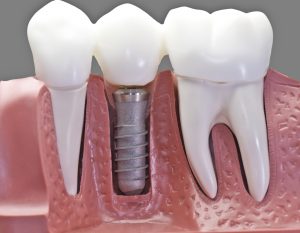 crown and bridge with dental implants.