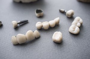 implant-retained dentures and traditional