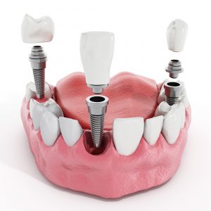 dental implants supporting restoration