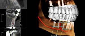 Fresno dental implants