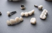 implant-retained dentures and traditional