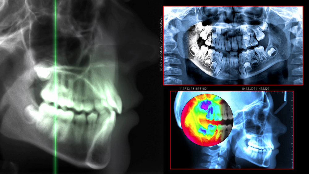 Dental Cone Beam Computed Tomography (CBCT) for Precise Treatment ...